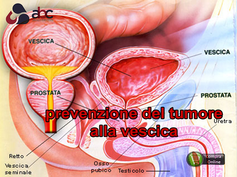 tumore-della-vescica